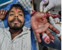 Palwal/Hodal News: प्रतिबंधित चाइनीज मांझे की चपेट में आने से मोटरसाइकिल सवार हुआ घायल